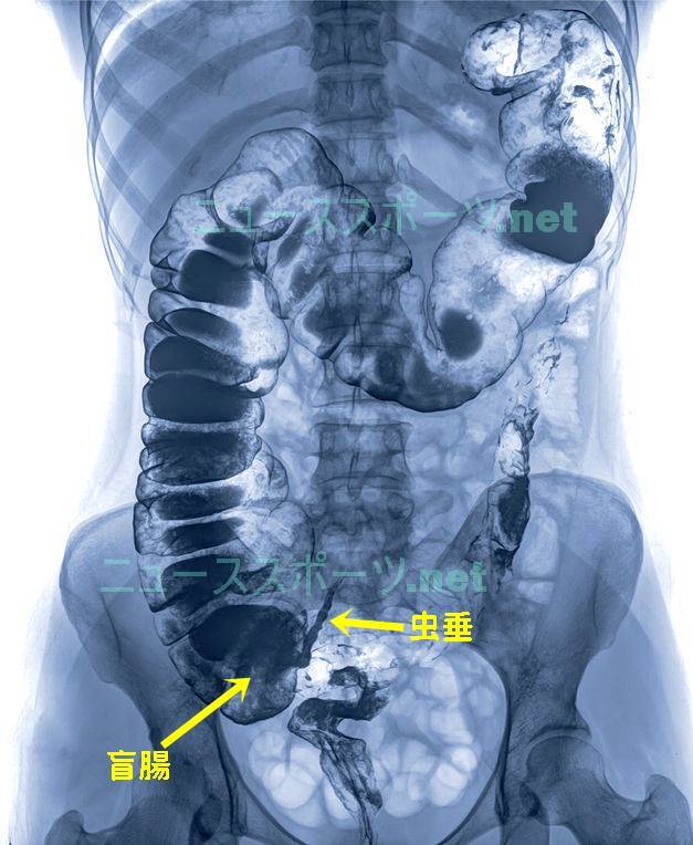 盲腸の痛みの場所を図や画像で解説！左じゃなくて右下腹部です1