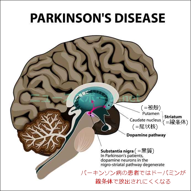 パーキンソン病の芸能人や有名人は？初期症状や原因、治療もご紹介2